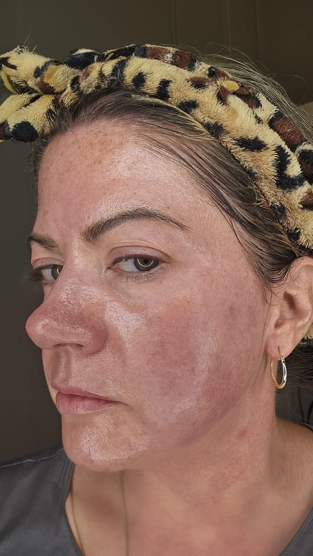 Sarah's dark spot transformation | Methodiq