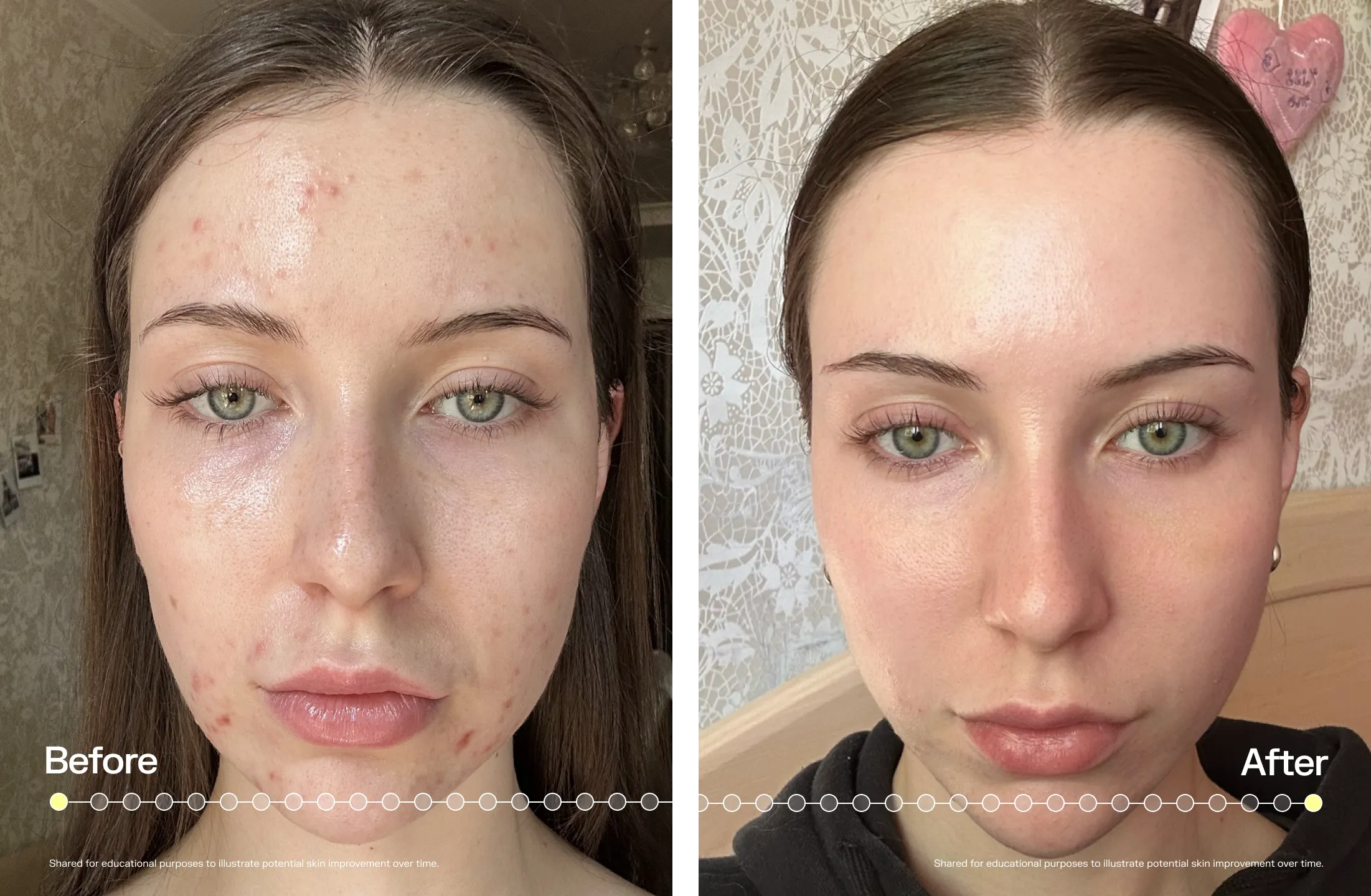 Acne Front 5 Reasons Clarixa is the acne solution your routine is missing | Methodiq